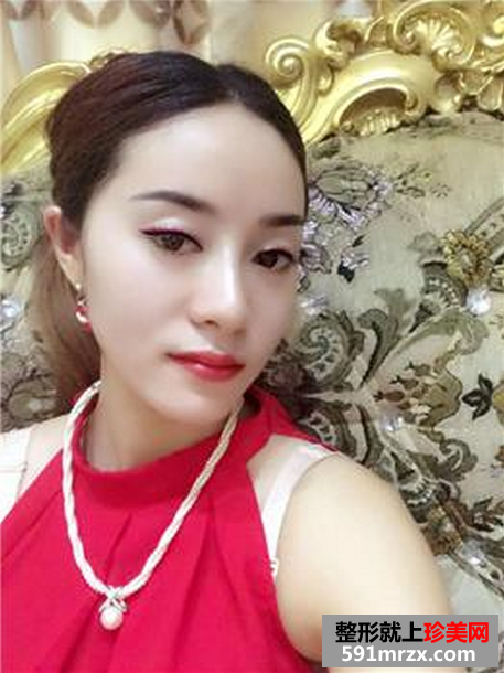 假体隆鼻真实对比图