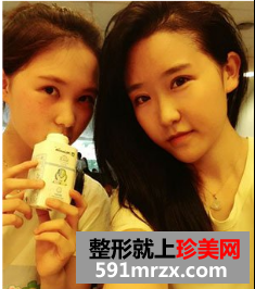 割双眼皮多久恢复自然 北京京美割双眼皮案例