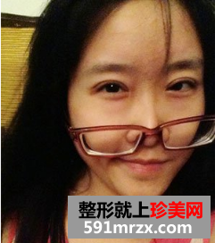 割双眼皮多久恢复自然 北京京美割双眼皮案例