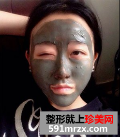 割双眼皮多久恢复自然 北京京美割双眼皮案例