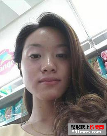 假体隆鼻真实对比图