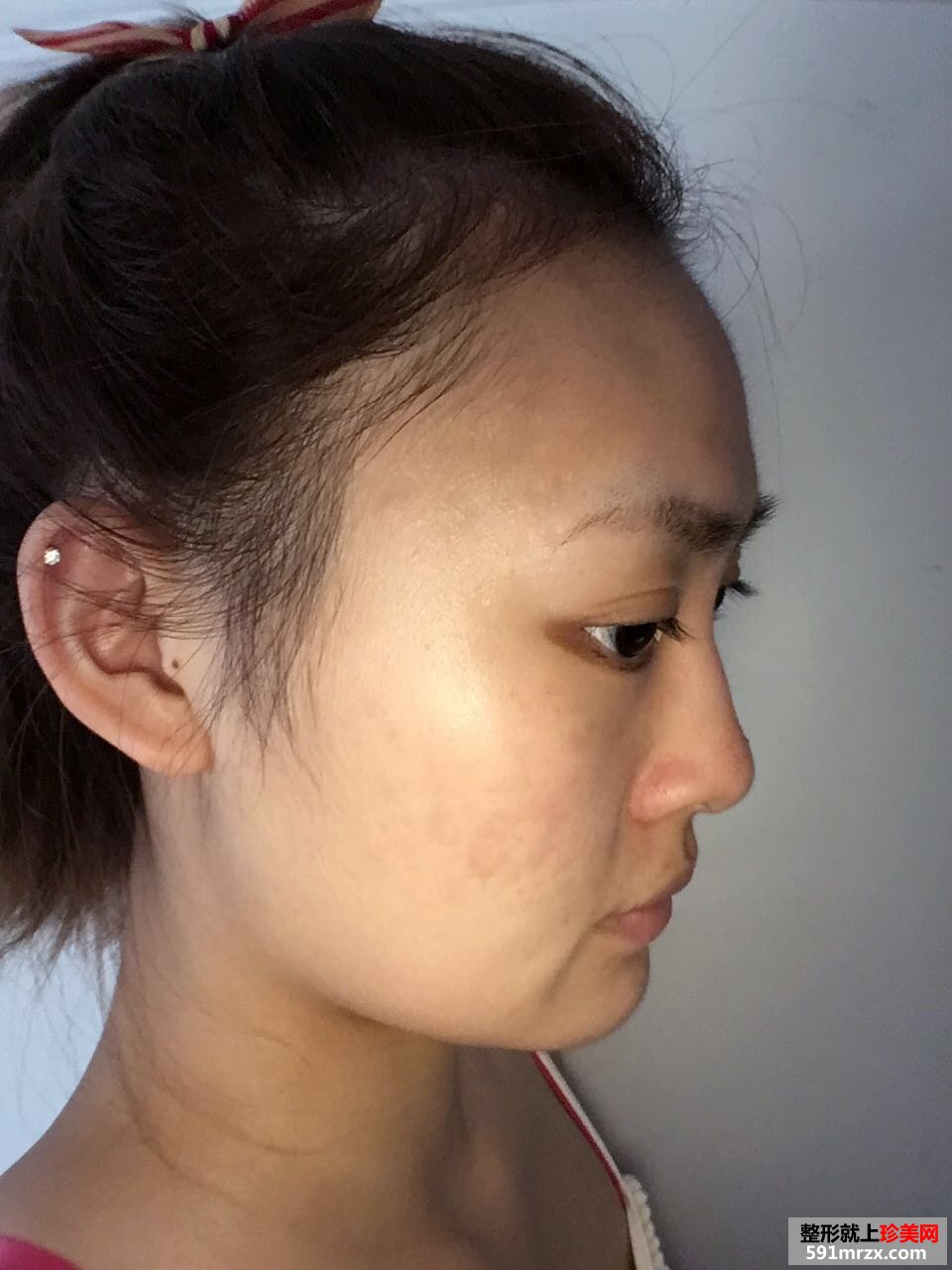 玻尿酸丰下巴加嘴唇真实对比图