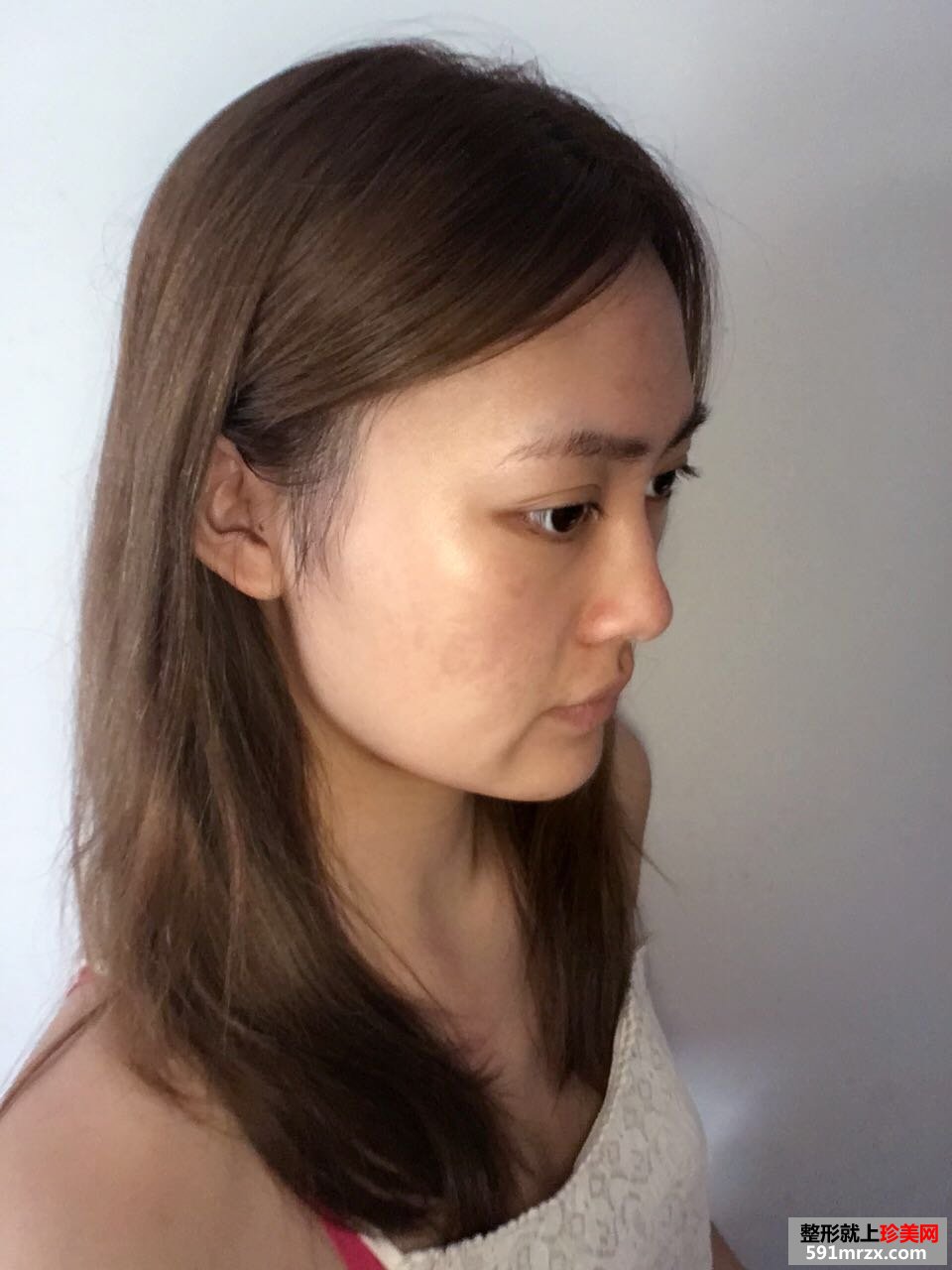 玻尿酸丰下巴加嘴唇真实对比图