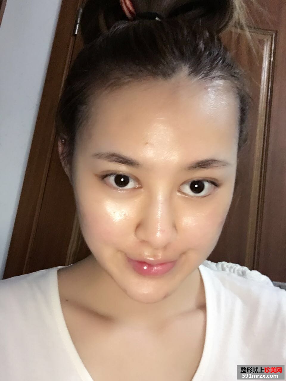 玻尿酸丰下巴加嘴唇真实对比图