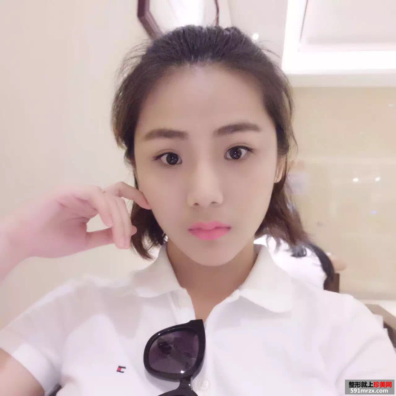 玻尿酸丰下巴加嘴唇真实对比图
