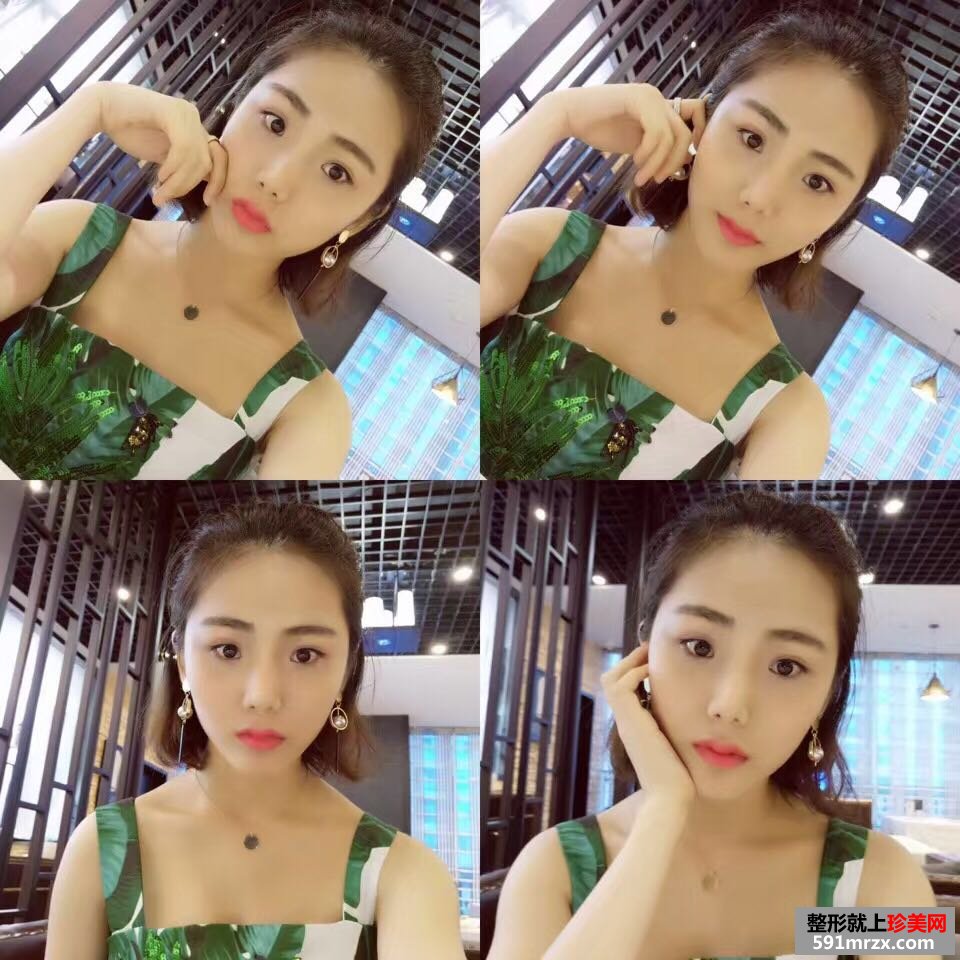 玻尿酸丰下巴加嘴唇真实对比图