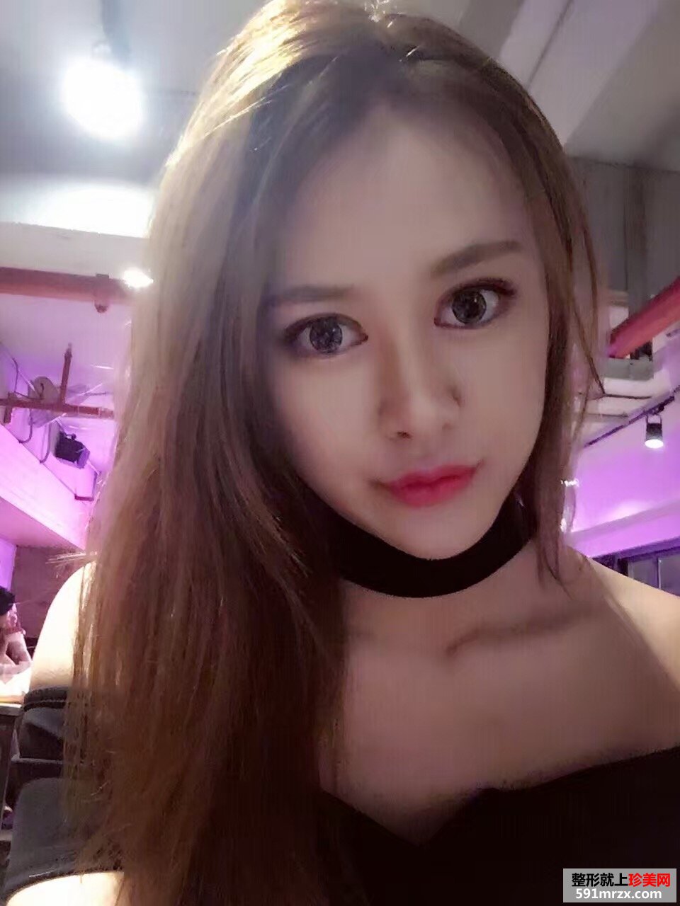 玻尿酸丰下巴加嘴唇真实对比图