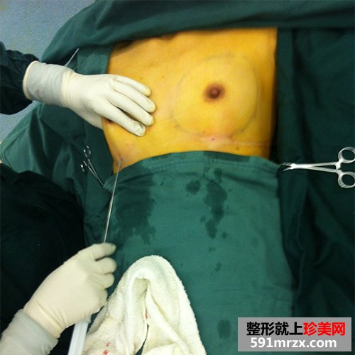 自体脂肪丰胸术真实案例对比图