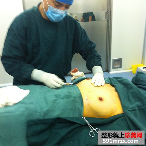 自体脂肪丰胸术真实案例对比图