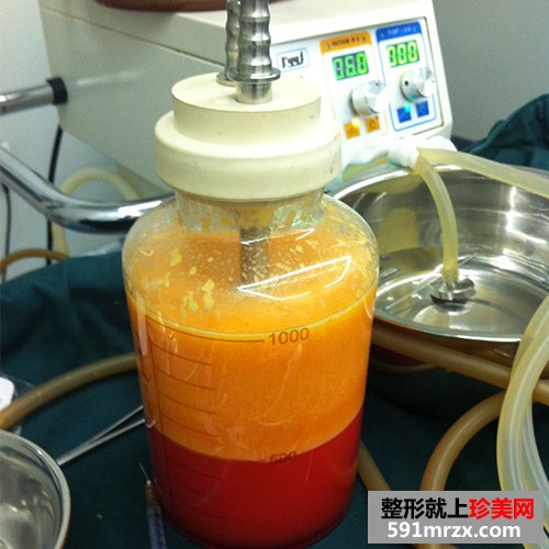 自体脂肪丰胸术真实案例对比图