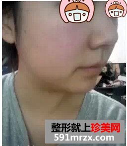 瘦脸针真实案例对比图
