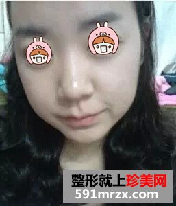 瘦脸针真实案例对比图