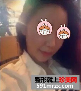 瘦脸针真实案例对比图