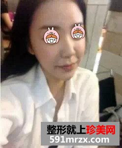 瘦脸针真实案例对比图