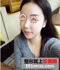 瘦脸针真实案例对比图