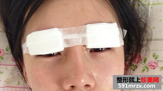 双眼皮术后4个月恢复不错了 分享给大家