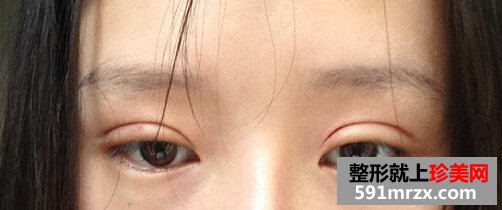 双眼皮术后4个月恢复不错了 分享给大家