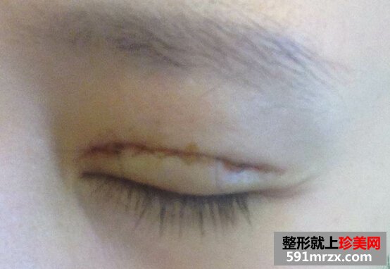 双眼皮术后4个月恢复不错了 分享给大家
