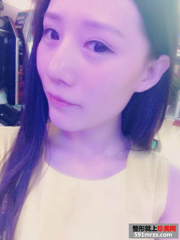 双眼皮术后4个月恢复不错了 分享给大家