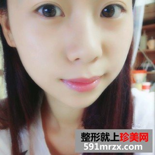 打瘦脸针三个月了 脸小了一大圈