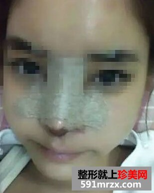 做完假体隆鼻恢复超棒 更加漂亮有自信了