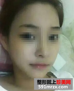 做完假体隆鼻恢复超棒 更加漂亮有自信了