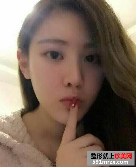 自体脂肪面部填充+鼻综合整形案例分享