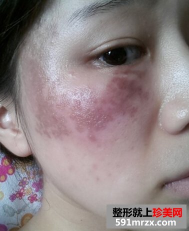 妹纸做了激光祛斑后脸变得白皙光滑了