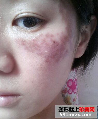 妹纸做了激光祛斑后脸变得白皙光滑了