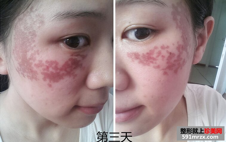 妹纸做了激光祛斑后脸变得白皙光滑了