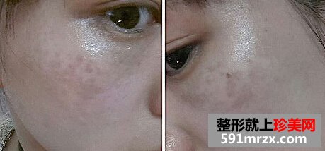 妹纸做了激光祛斑后脸变得白皙光滑了