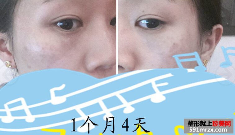 妹纸做了激光祛斑后脸变得白皙光滑了
