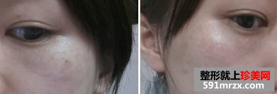 妹纸做了激光祛斑后脸变得白皙光滑了
