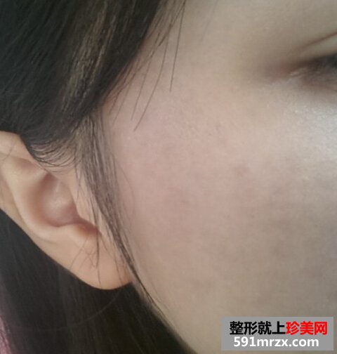 妹纸做了激光祛斑后脸变得白皙光滑了