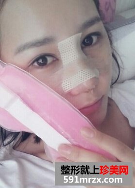 隆鼻失败后修复 效果确实不错