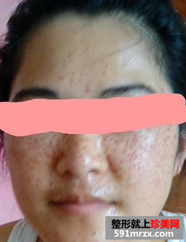 长春中研激光去斑前后对比