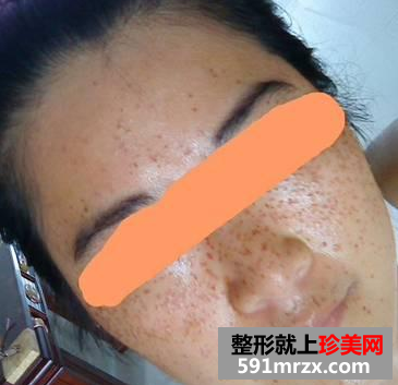长春中研激光去斑前后对比