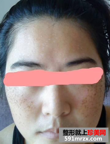 长春中研激光去斑前后对比