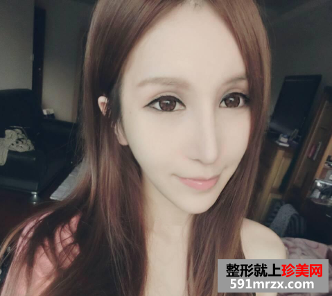广州美莱开眼角前后对比照片图