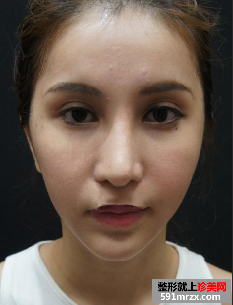 广州美莱开眼角前后对比照片图