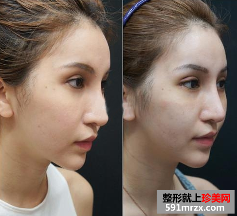 广州美莱开眼角前后对比照片图