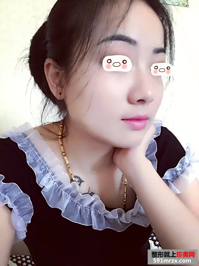 超声刀除皱真实案例恢复图