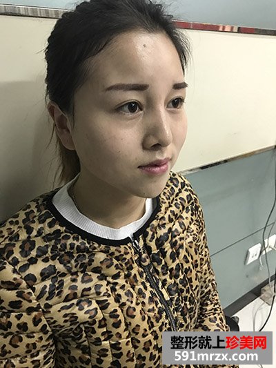 玻尿酸填充泪沟真实案例恢复过程图