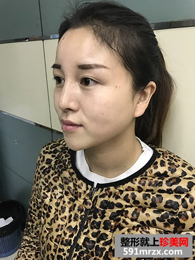玻尿酸填充泪沟真实案例恢复过程图