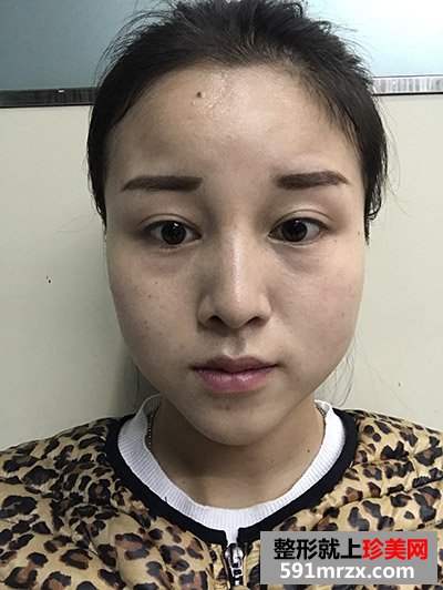 玻尿酸填充泪沟真实案例恢复过程图