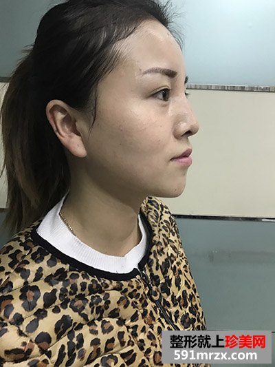 玻尿酸填充泪沟真实案例恢复过程图