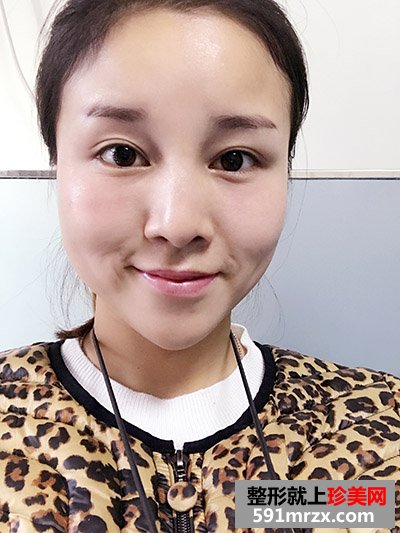 玻尿酸填充泪沟真实案例恢复过程图