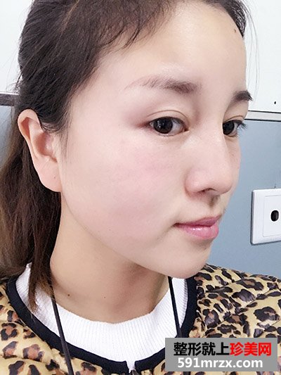 玻尿酸填充泪沟真实案例恢复过程图