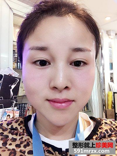 玻尿酸填充泪沟真实案例恢复过程图