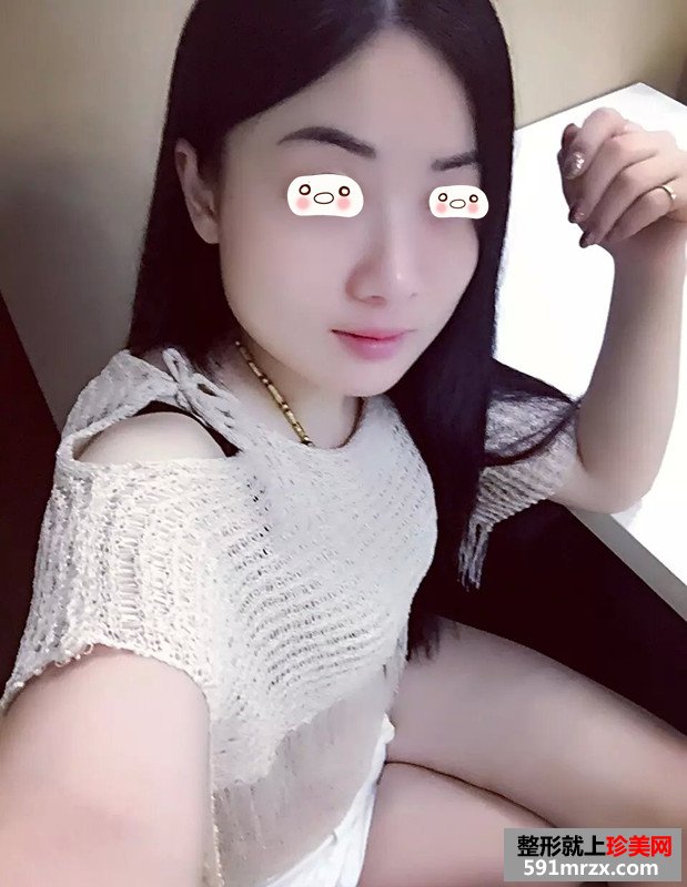 超声刀除皱真实案例恢复图